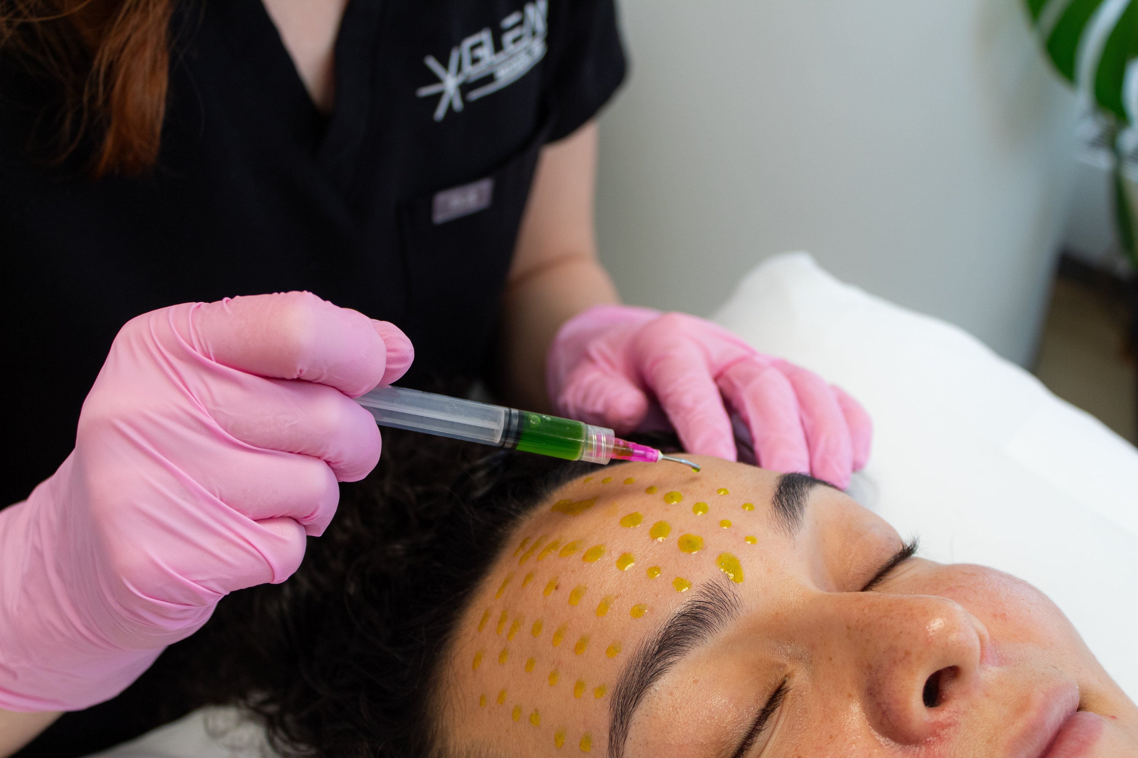 Chemical Peels